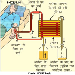 Dialysis or Artificial Kidney